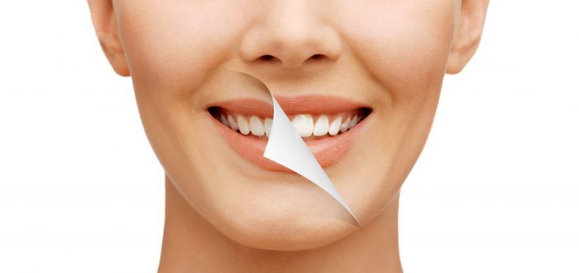 Smile Enhancement